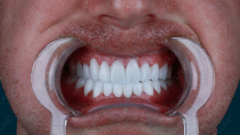 Hollywood smile experience 